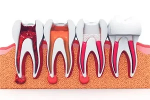 4 Signs You Need a Root Canal