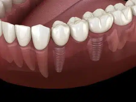 What to Expect During Your Dental Implant Consultation vistadentistry