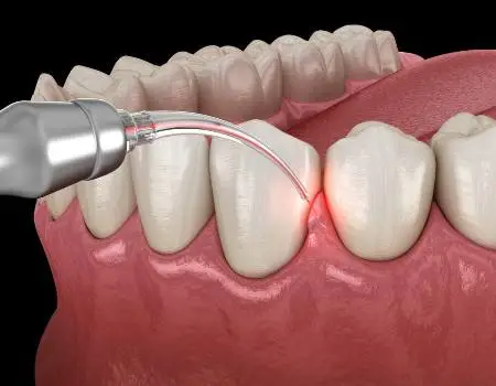 Laser Periodontal Therapy: Our State-of-the-Art Gum Disease Treatment vistadentistry