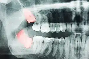 Should You Be Worrying About Your Wisdom Teeth?